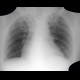 Pneumopericardium, postoperative: X-ray - Plain radiograph